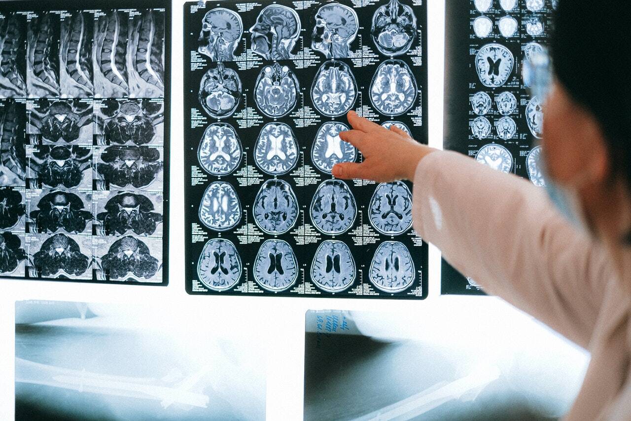 alzheimer-cognition